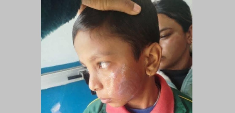 तनहुँमा पन्यु तताएर विद्यार्थीको गालामा डाम्ने शिक्षिका पक्राउ